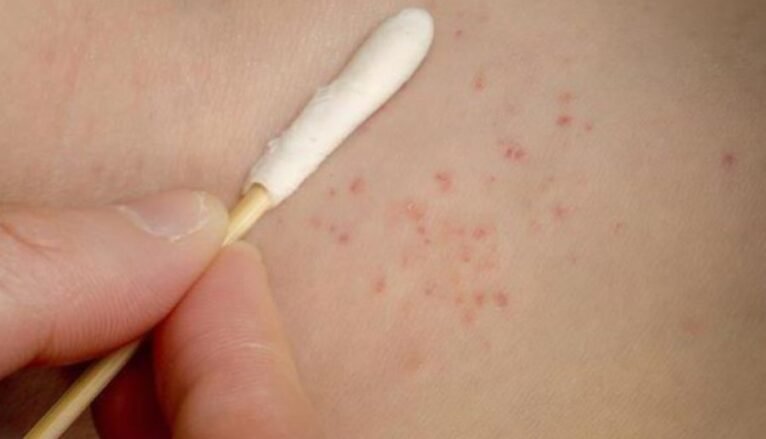 Italia në alarm, zgjebja po përhapet me shpejtësi, rastet u shtuan me 750% në tre vjet